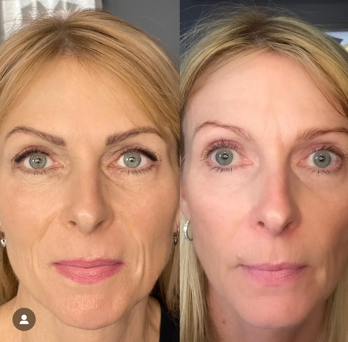 Eyebrow tattoo result — NeoTempo Aesthetics