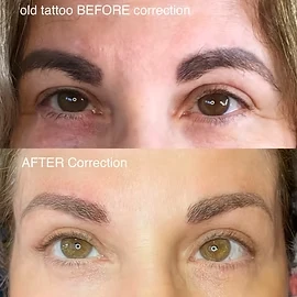 Tattoo Correction & Removal